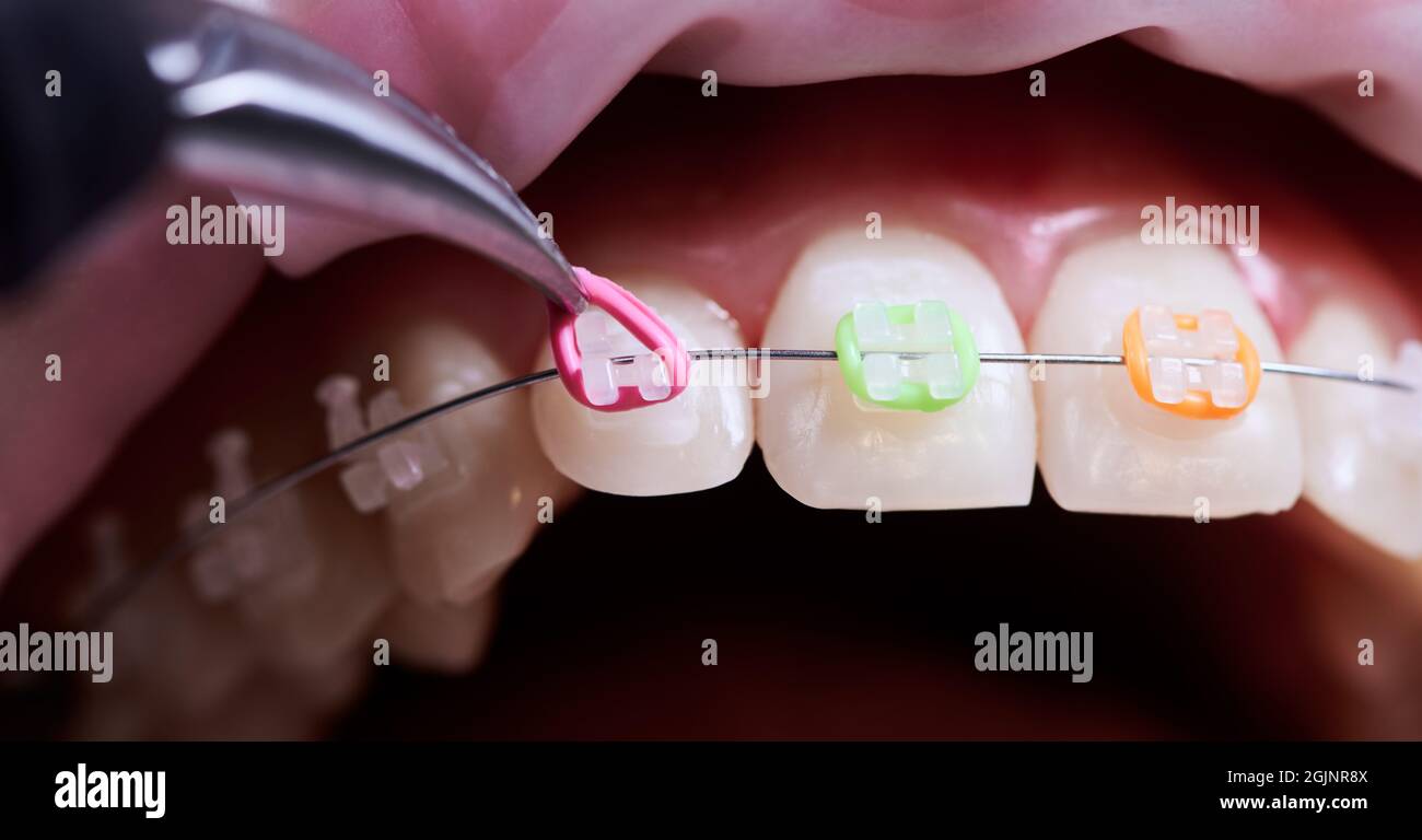 Braces teeth straightening hires stock photography and images Alamy