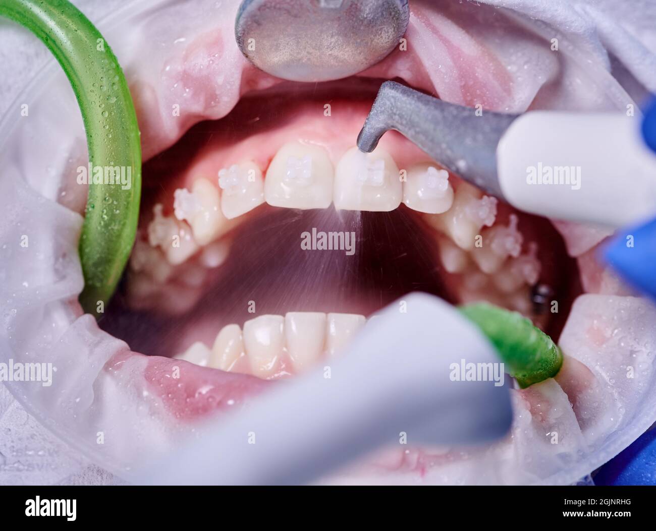 Close up of orthodontist using dental tools while cleaning teeth of