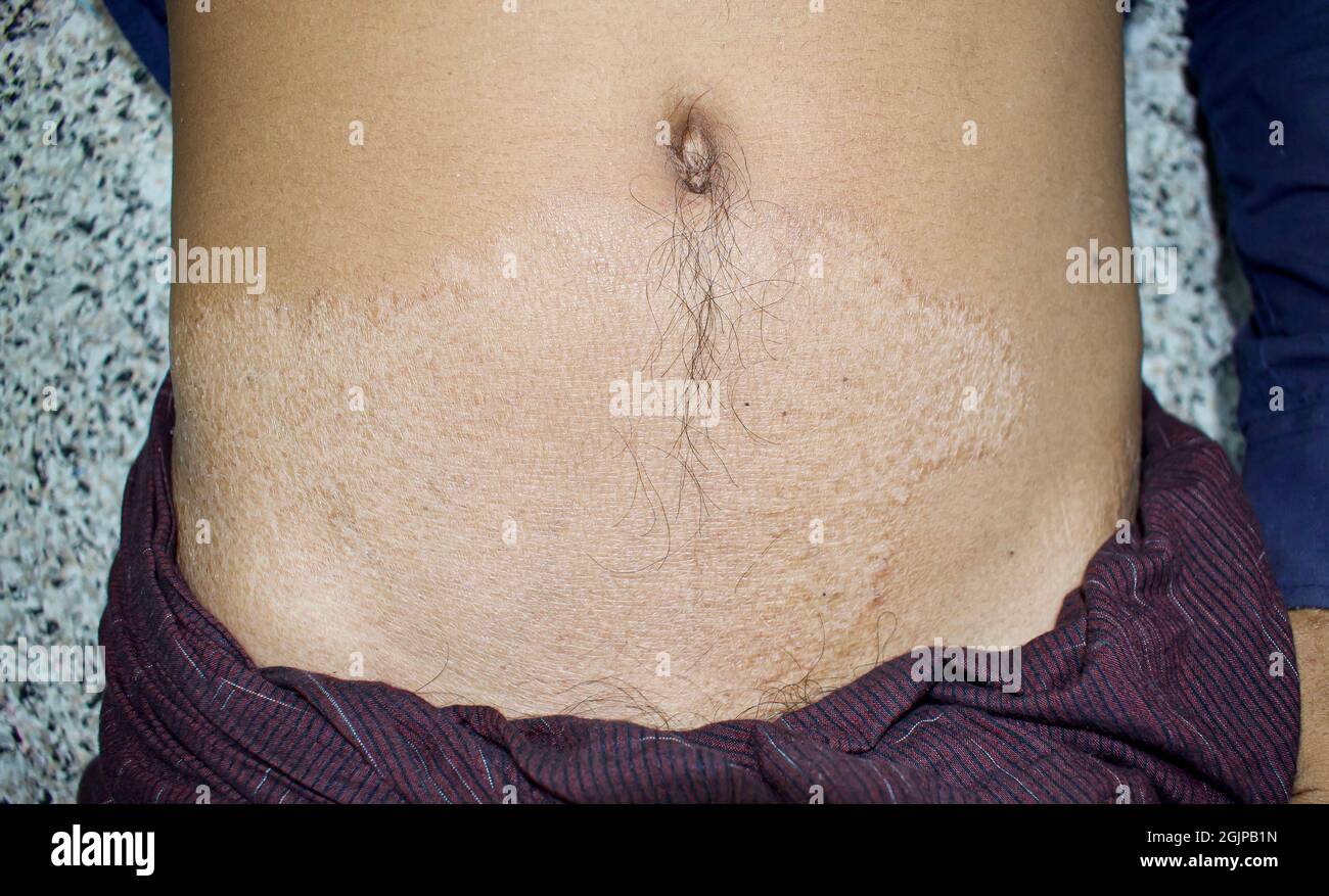 Fungal infection called tinea corporis in trunk of Asian young man. Widespread ringworm over abdomen. Stock Photo