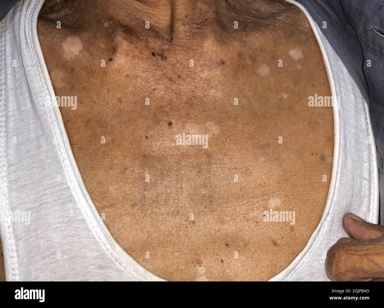 White spot lesions hires stock photography and images Alamy