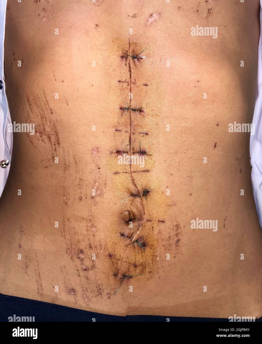 Laparotomy or midline incision at abdomen of Asian man. Stock Photo