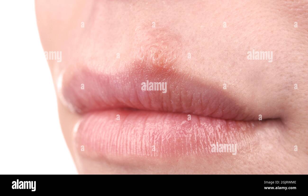 Herpes blisters on female lips closeup Stock Photo Alamy