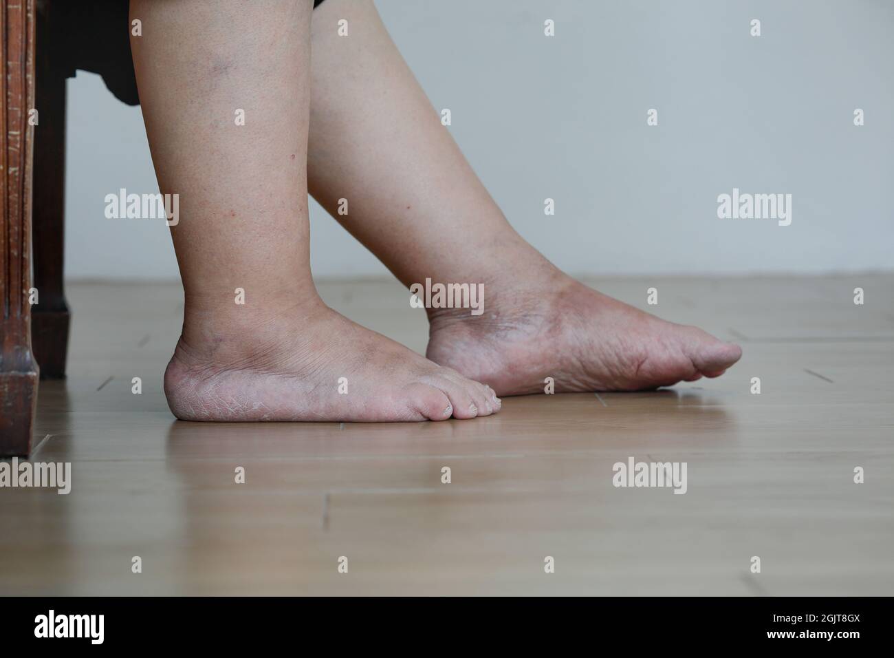 Older woman swollen feet hires stock photography and images Alamy