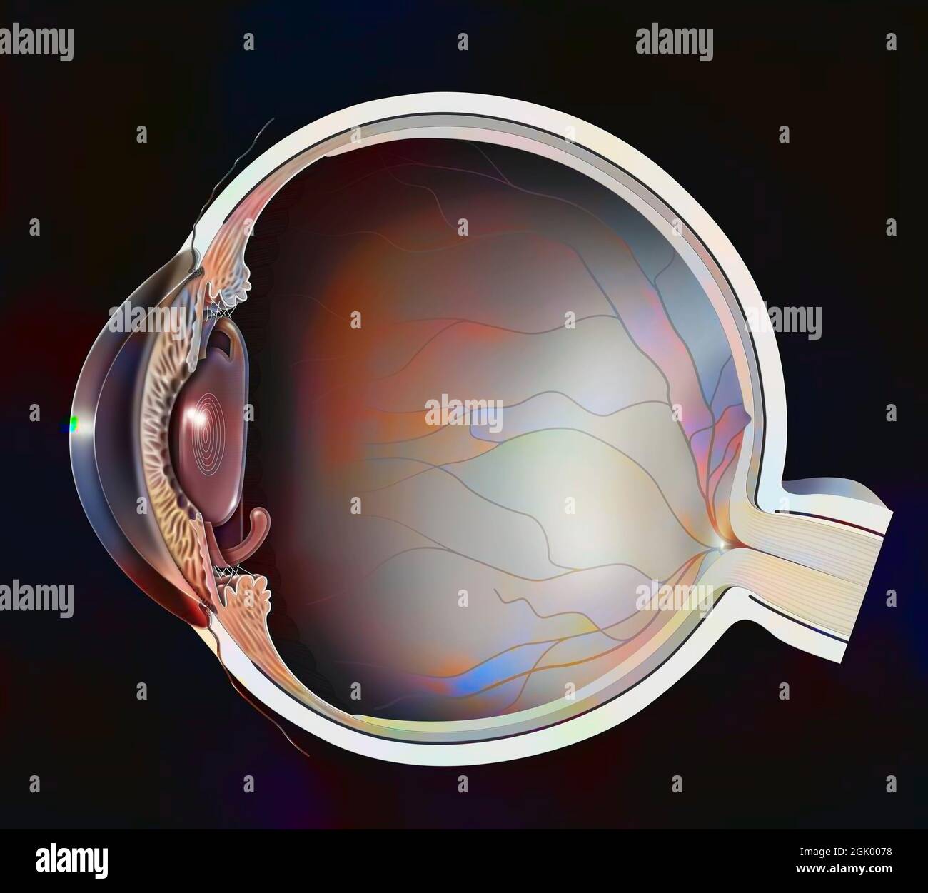 Eye, presbyopia multifocal implant inserted to replace the lens Stock Photo Alamy