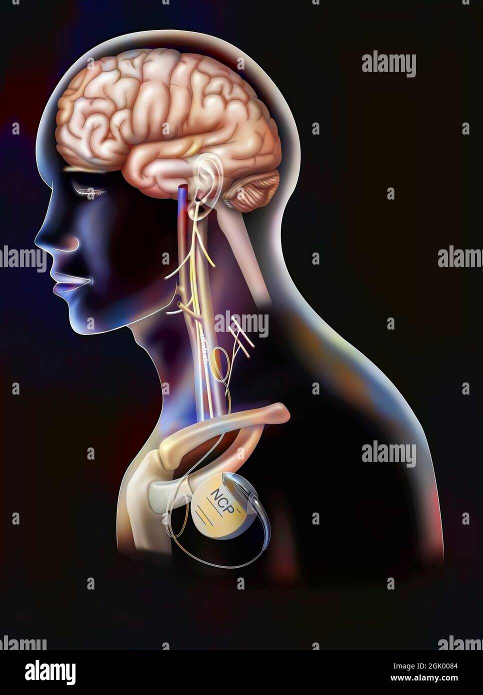 Treatment of epilepsy by stimulation of the vagus nerve with a neurostimulator box. Stock Photo