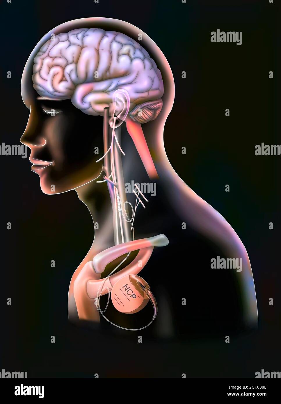 Treatment of epilepsy by stimulation of the vagus nerve with a neurostimulator box. Stock Photo