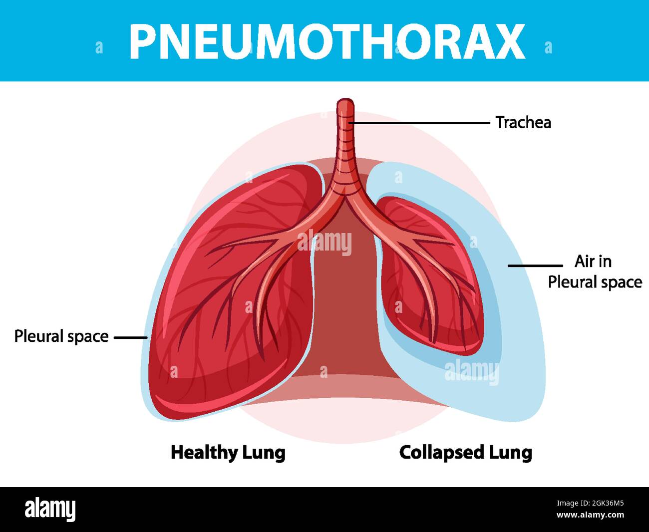 Pneumothorax diagram with collapsed lung and healthy lung illustration