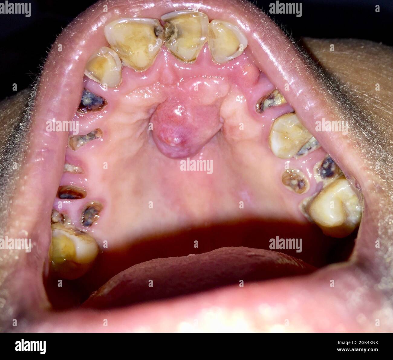 A painless benign growth called palatal torus in the midline of hard palate and broken and stained teeth with caries in the oral cavity of Southeast A Stock Photo