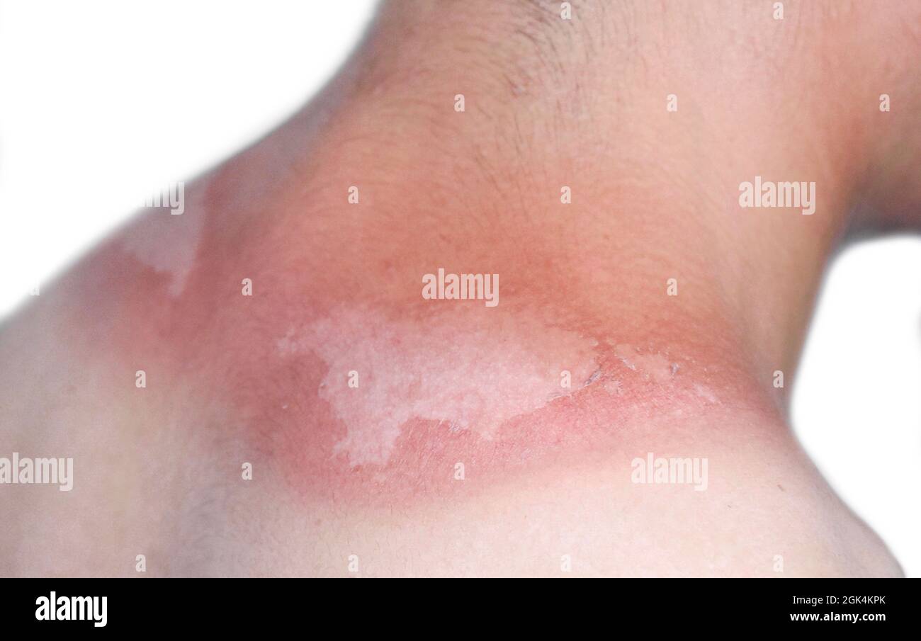 Painful burns hires stock photography and images Alamy