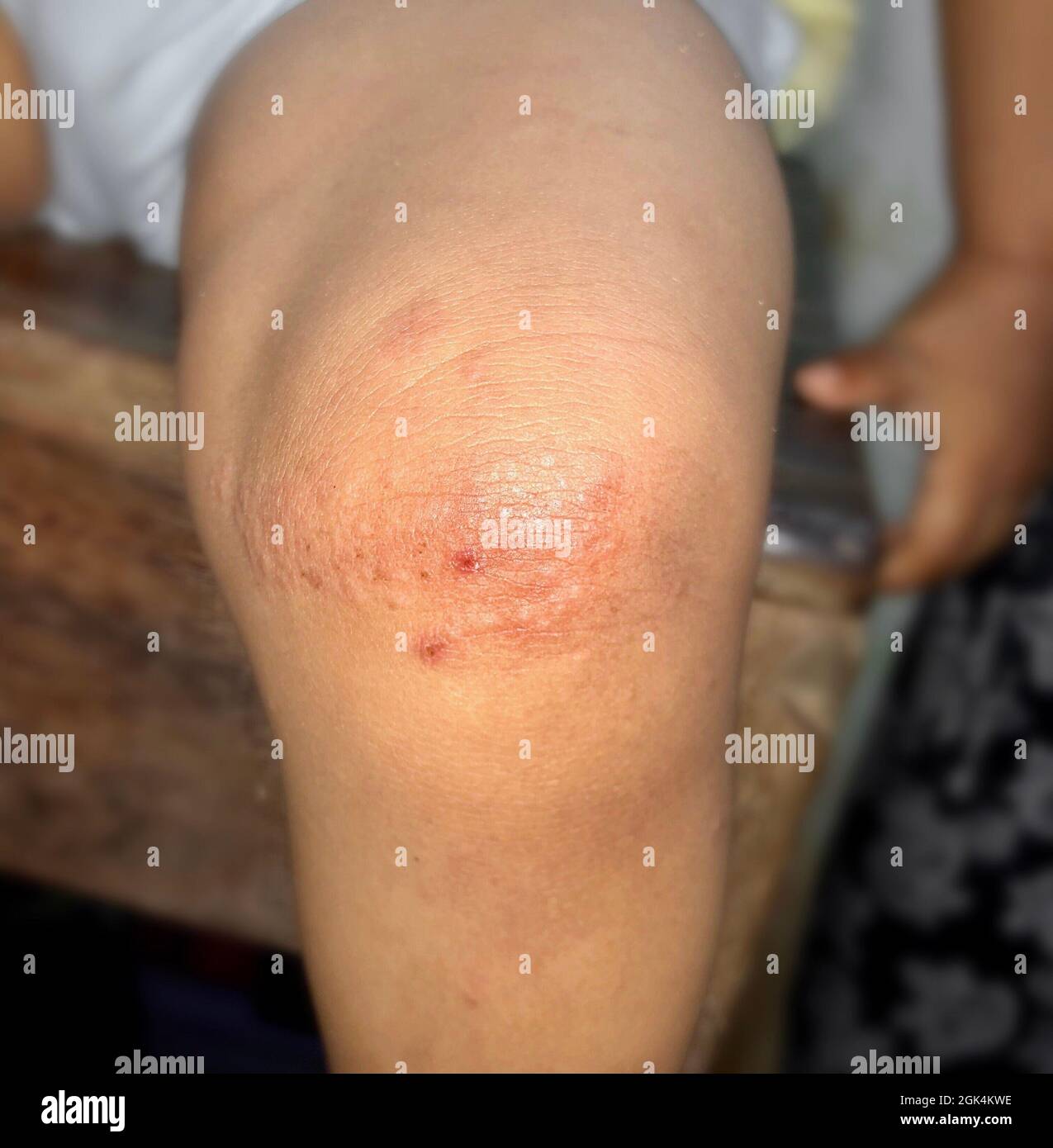 Fungal infection called tinea corporis in leg of Asian child. Widespread ringworm over knee area. Stock Photo