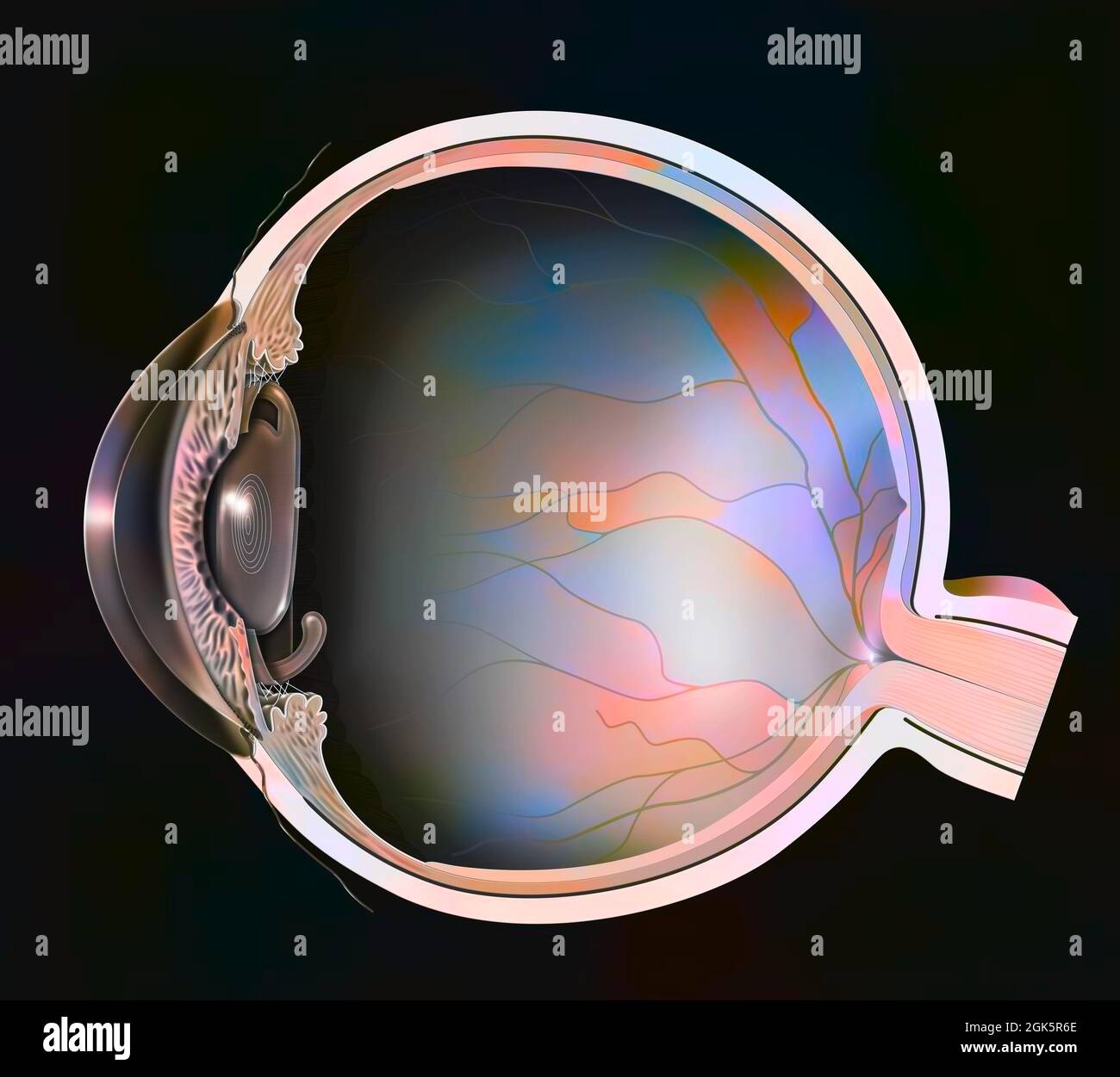 Eye, presbyopia multifocal implant inserted to replace the lens Stock