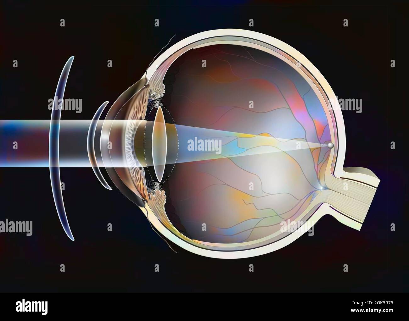 Presbyopic eye, various corrections possible: spectacle lens, - contact lens. . Stock Photo