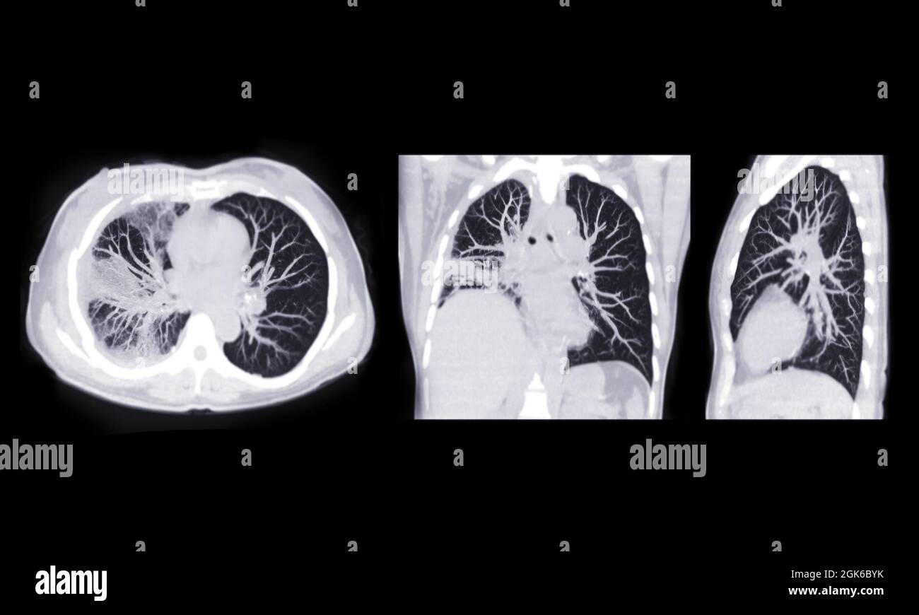 CT scan of Chest or lung axial, coronal and sagittal mip view of lung infection covid-19 with ground glass opacity . Stock Photo