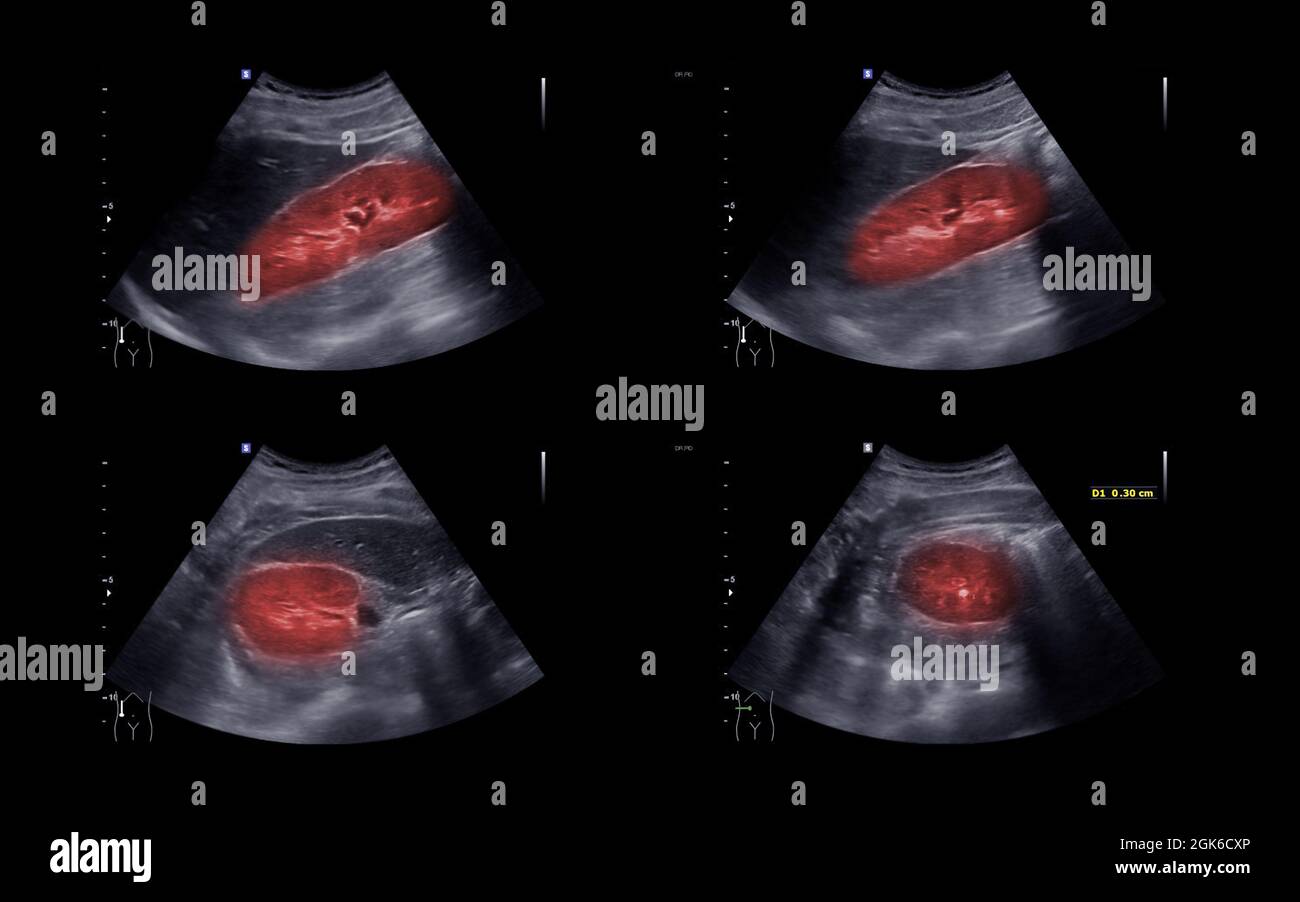 Ultrasound of Kidney or KUB for screening renal stone disease Stock