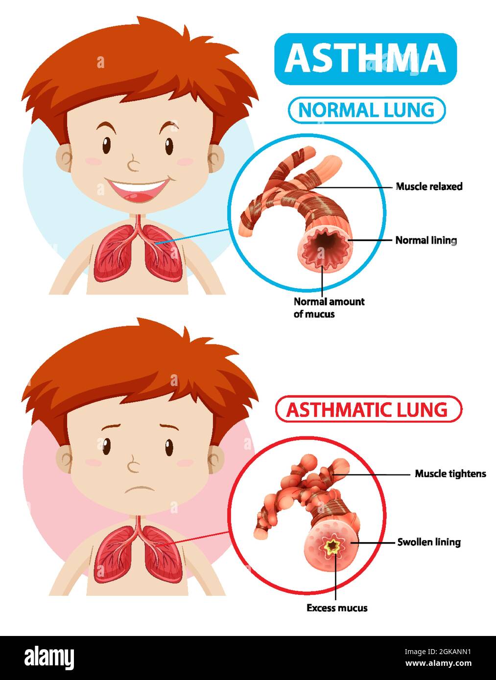 Asthma diagram with normal lung and asthmatic lung illustration Stock