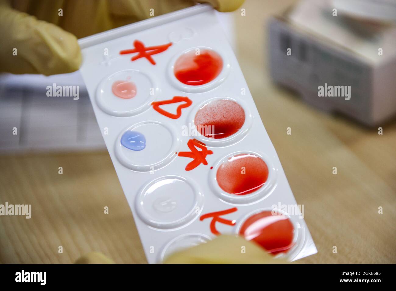 Blood Group Determination Stock Photo - Alamy