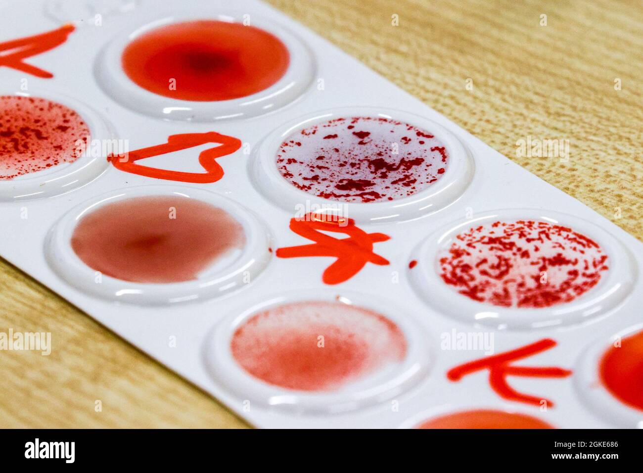 Blood group determination Stock Photo - Alamy