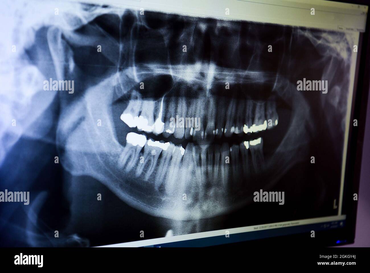 A dental X-Ray is displayed on a computer monitor in a patient care room at the 31st Dental Squadron on Aviano Air Base, Italy, April 20, 2021. The prophylactic section within the 31st DS  primarily conducts annual dental appointments that entail looking for and identifying cavities, checking for oral cancers, overall gum and teeth health and raising dental wellness procedures to the patient. A variety of procedures to the patient. A variety of procedures are performed to identify these during the annual appointment including X-Rays. Stock Photo