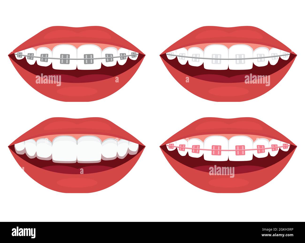teeth alignment. Metal, ceramic, plastic, ligature and invisible braces Stock Vector Image & Art