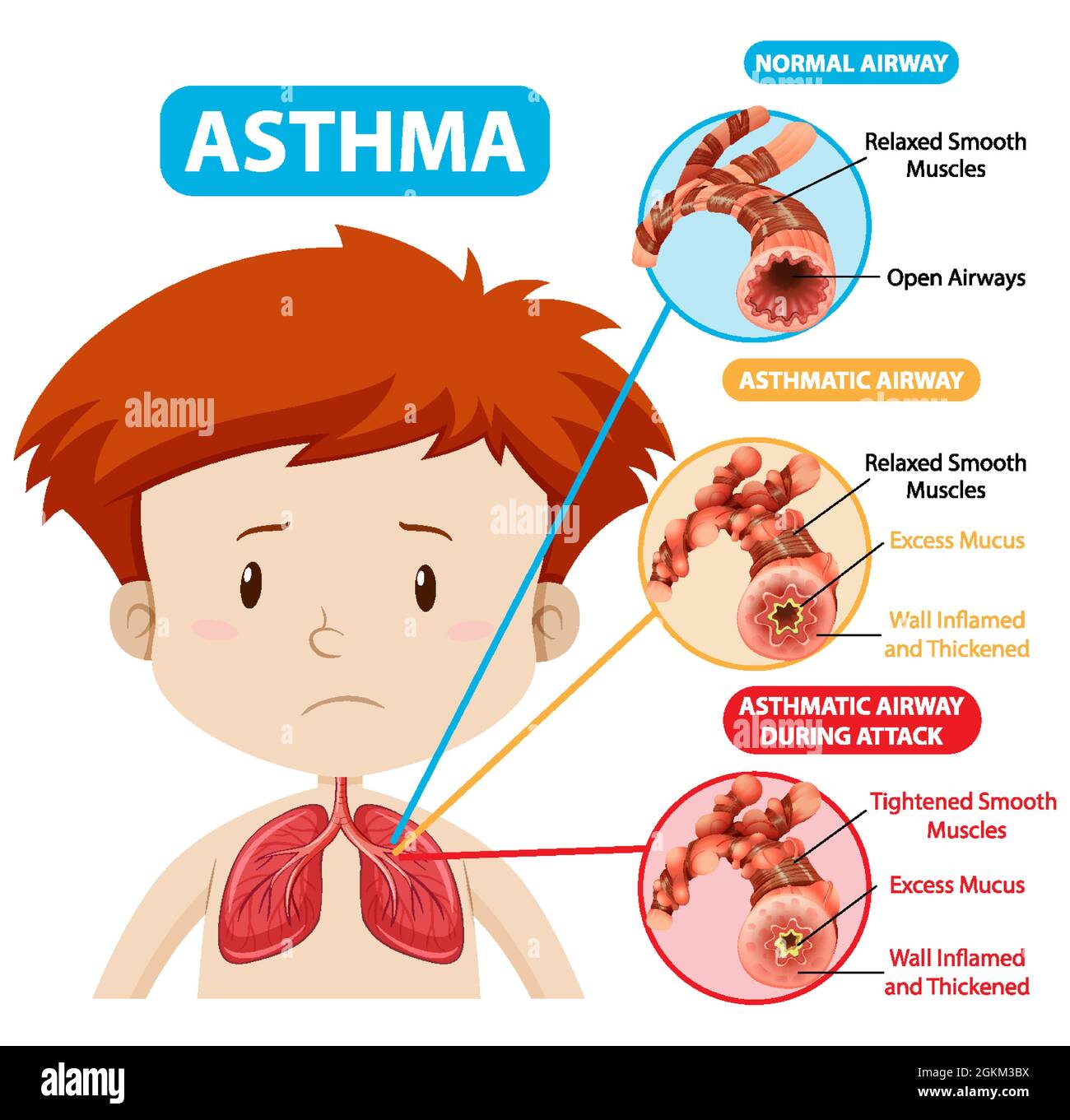 Asthma diagram with normal airway and asthmatic airway illustration