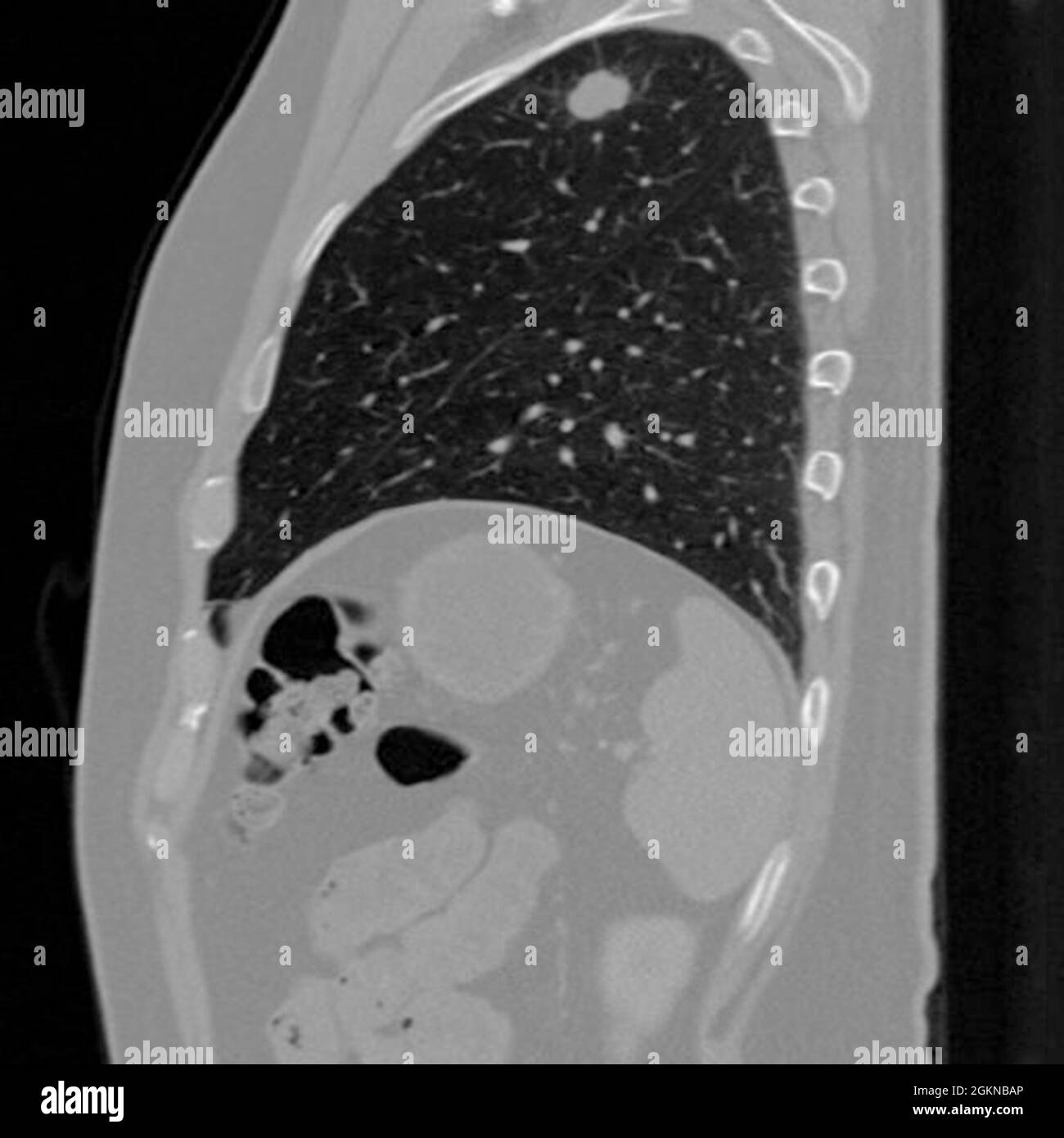 Side view Chest CT scan (X-ray computed tomography) of a male 54 year old patient. A tumour can be seen in the  left upper lobe of his lungs Stock Photo