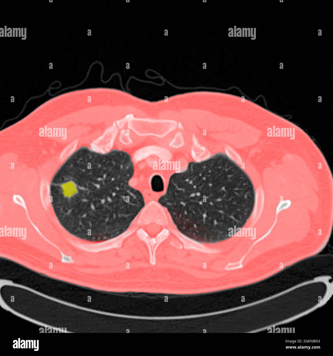 Chest CT scan (X-ray computed tomography) of a male 54 year old patient. A tumour can be seen in the  left upper lobe of his lungs Stock Photo