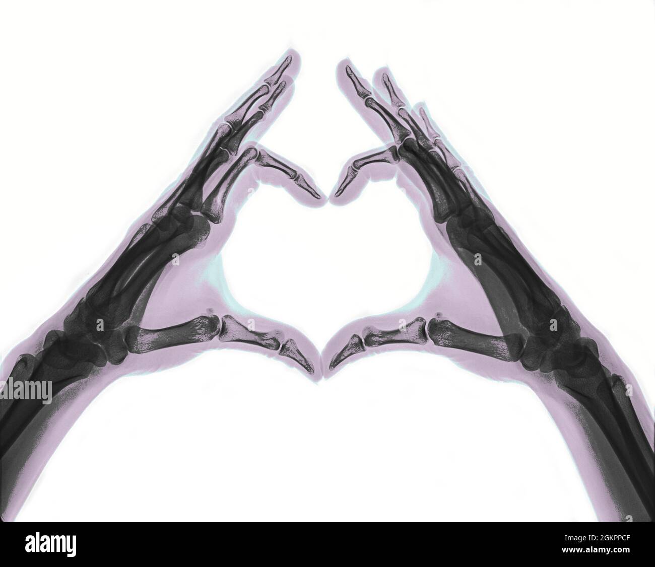 X-ray of hands forming a heart shape Stock Photo