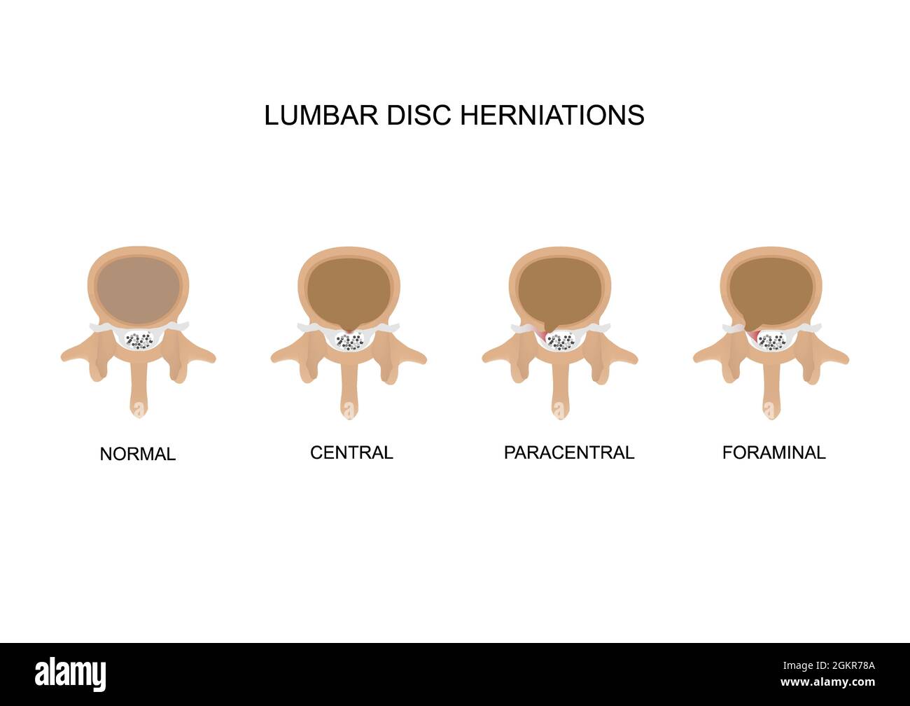 Vector illustration types of lumbar intervertebral disc herniation. Central, paracentral and foraminal disc herniation. Stock Vector
