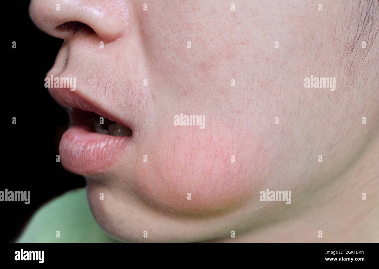 Swelling at the cheek of Asian man. Abscess formation. Stock Photo