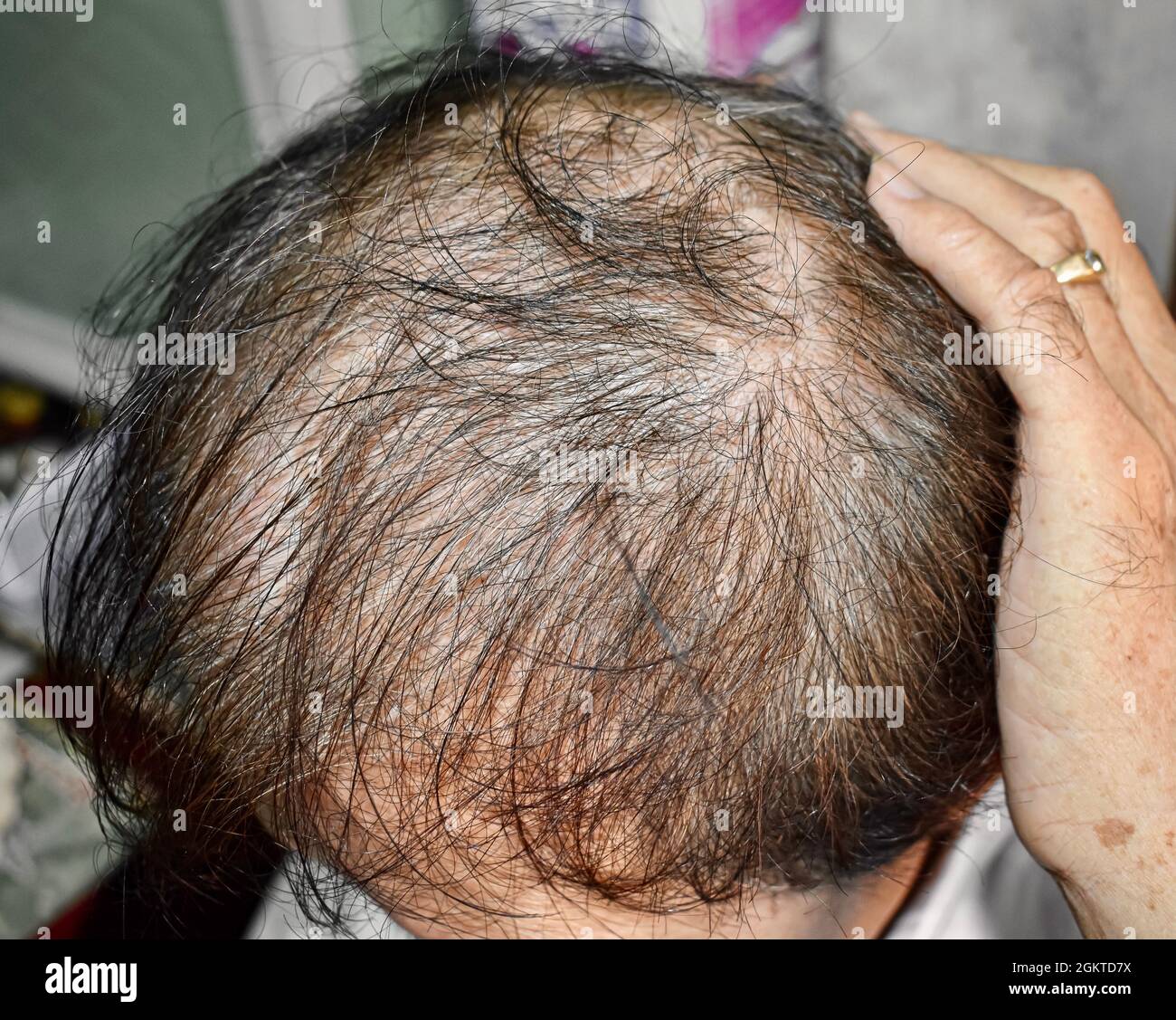 Thinning or sparse hair, male pattern hair loss in Southeast Asian, Chinese  elder man Stock Photo - Alamy