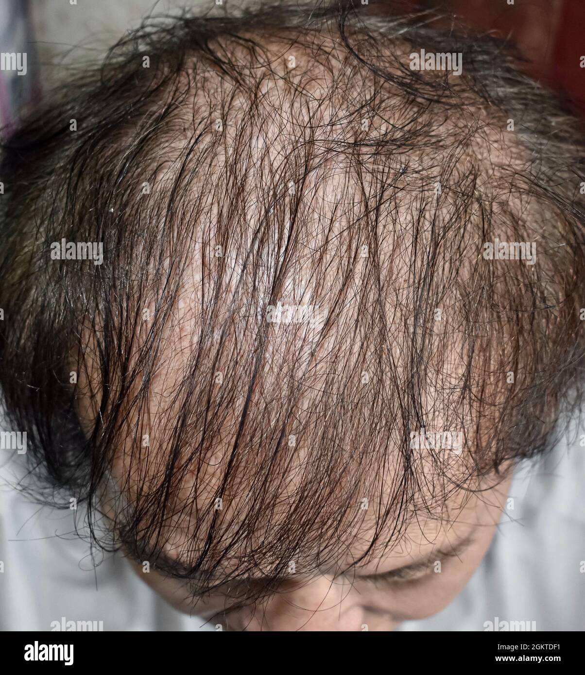 Thinning or sparse hair, male pattern hair loss in Southeast Asian, Chinese elder man. Stock Photo