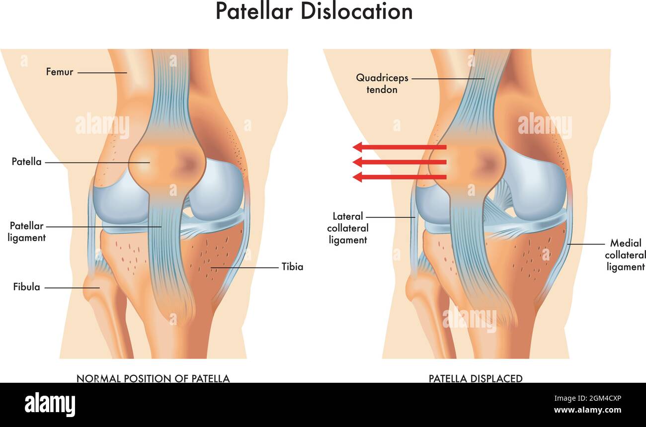 Medical illustration of symptoms of patellar dislocation, with annotations. Stock Vector