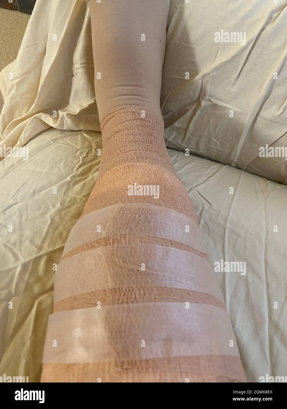 Recovering from vein ablation laser surgery and phlebectomy of the