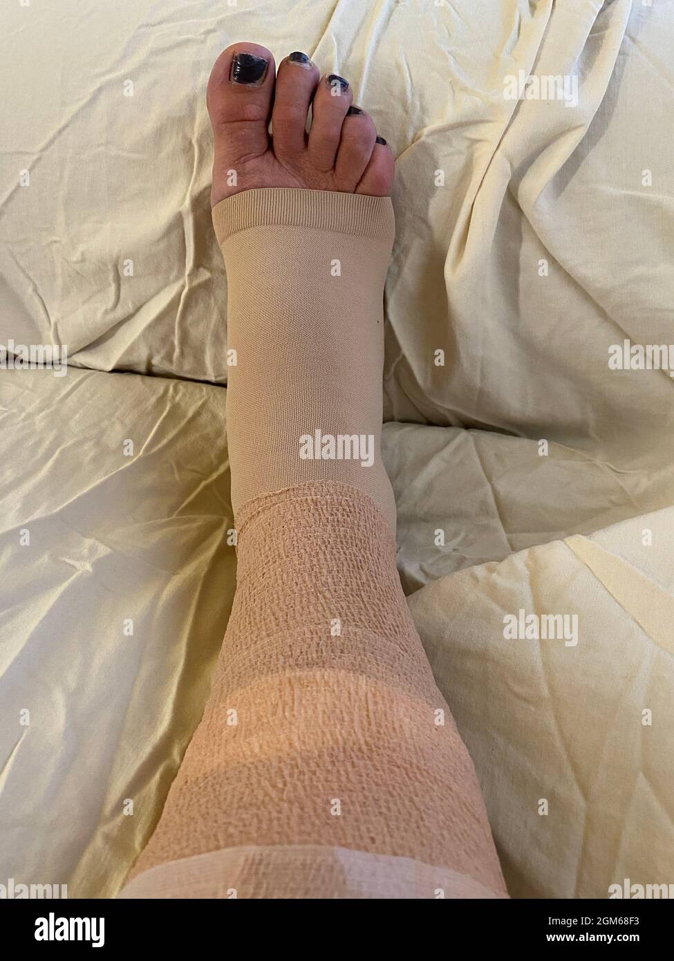 Recovering from vein ablation laser surgery and phlebectomy of the