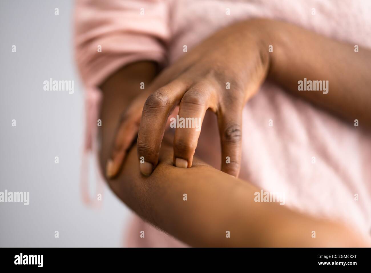 African American Woman With Itchy Skin. Allergy Or Psoriasis Stock Photo