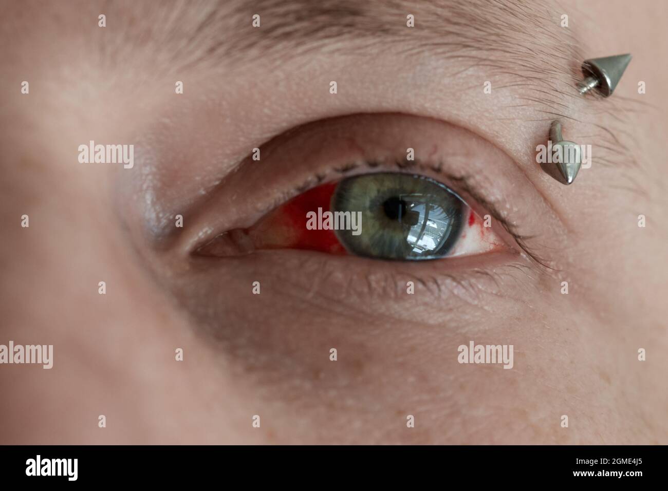 Injured blood vessel hires stock photography and images Alamy