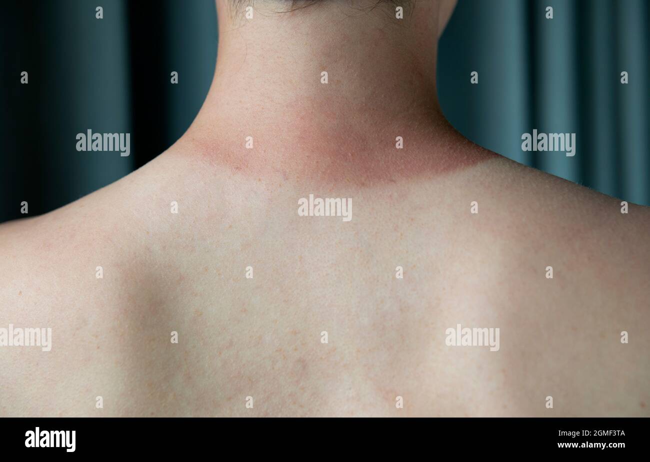 Harsh tan line formed from of a sunburn - back view Stock Photo