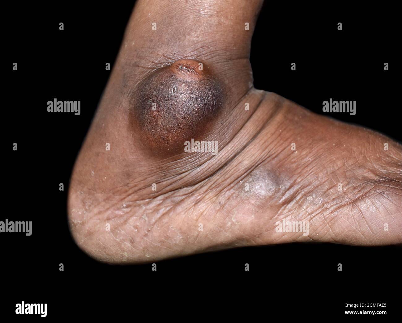 Abscess or Staphylococcal, Streptococcal skin infection at lateral malleolus of Asian Burmese male patient. Stock Photo