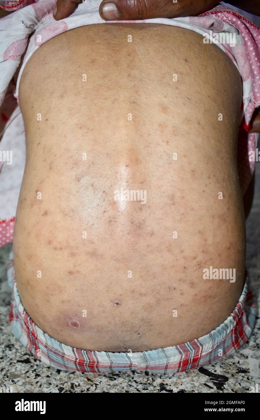 Scabies Infestation in back of Southeast Asian child. Widespread itching lesions over trunk. Stock Photo