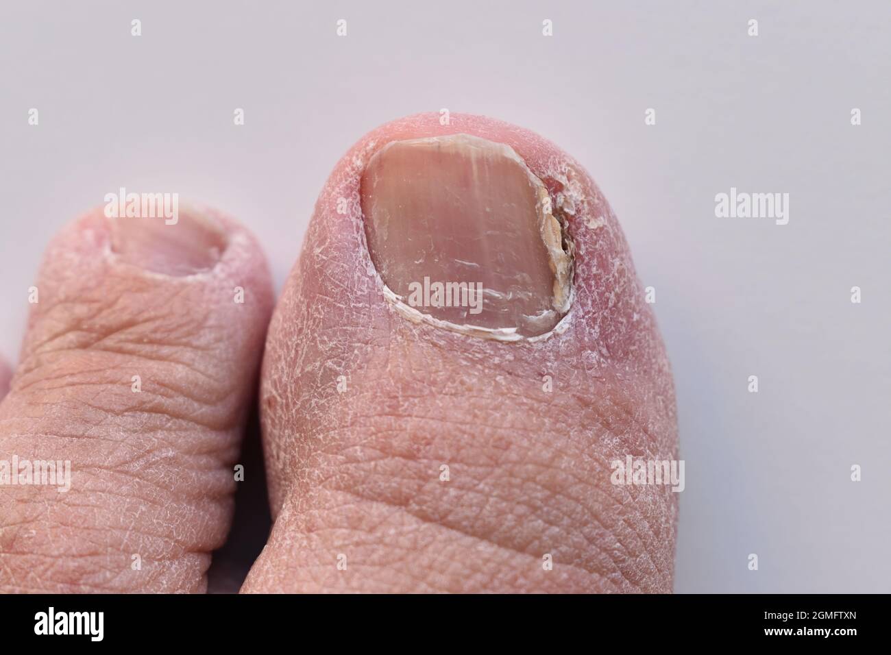 Nail fungus infection, onychomycosis, on foot thumb. Fungal infection on nail foot. Stock Photo