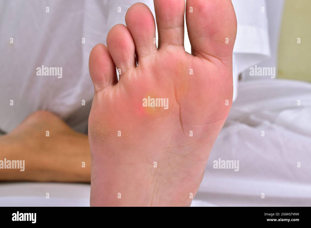 hyperkeratosis in foot, female foot corn problem Stock Photo