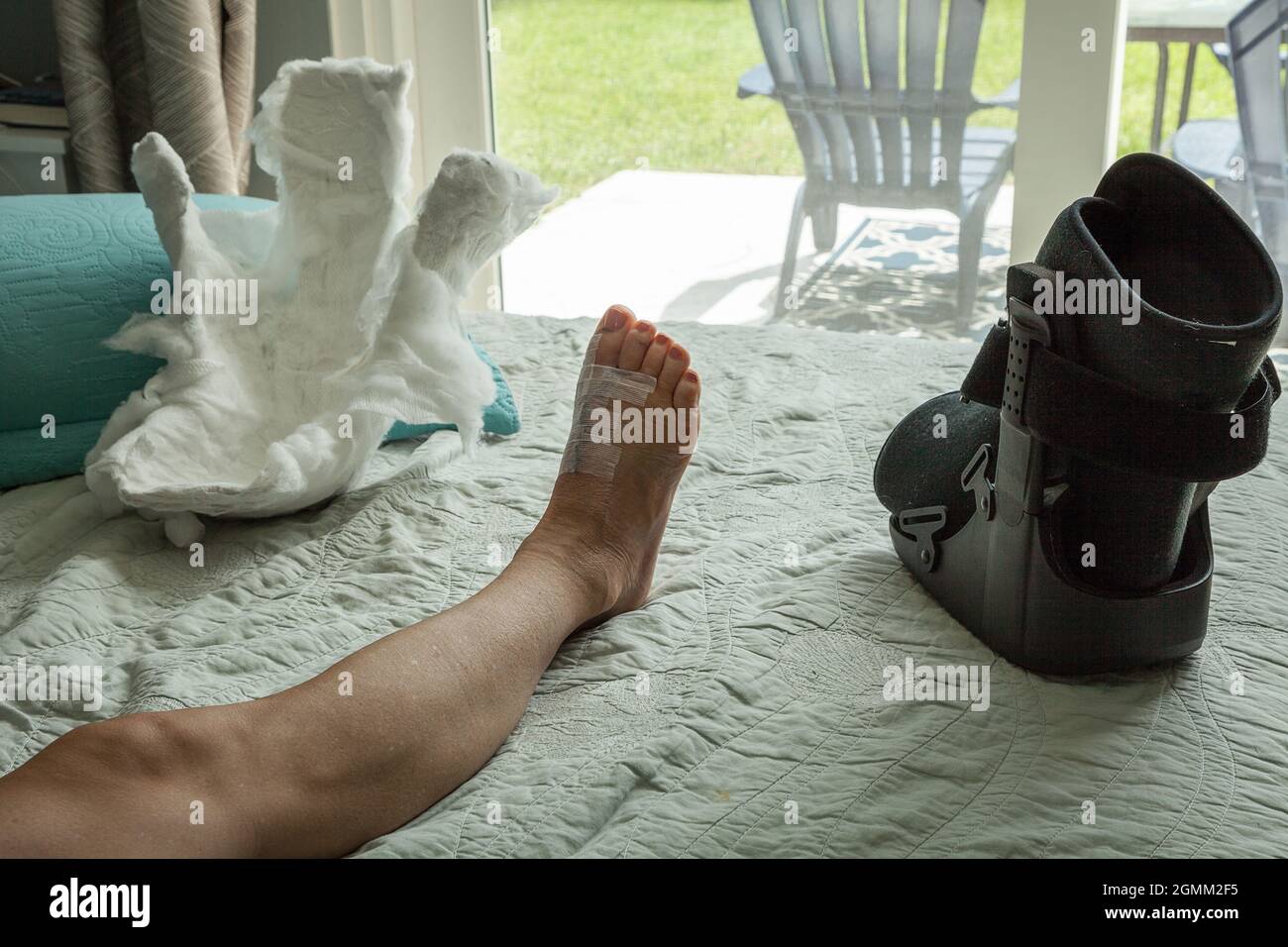 Cast removed from a foot after bunion surgery as the leg is elevated and  resting Stock Photo - Alamy