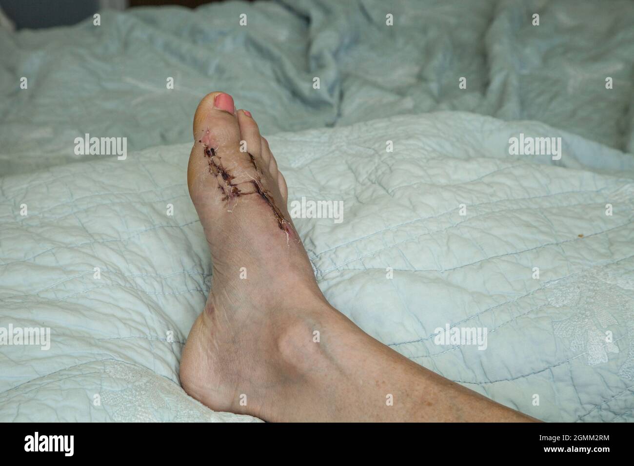 Stitches removed and foot elevated after bunion surgery on a bed Stock