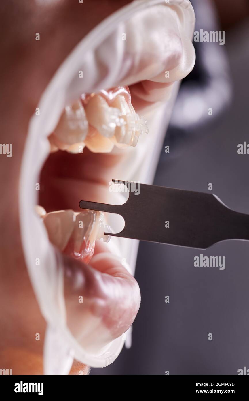 Close up of orthodontist checking height of bracket placement with aluminum gauge. Patient with cheek retractor in mouth and braces on teeth. Concept of dentistry and orthodontic treatment. Stock Photo