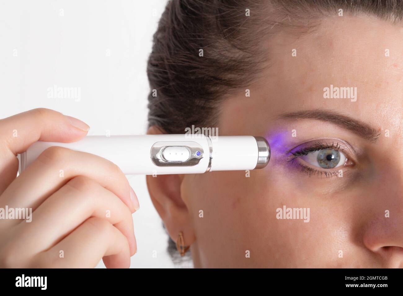 Professional removal of skin scars using laser resurfacing. The girl