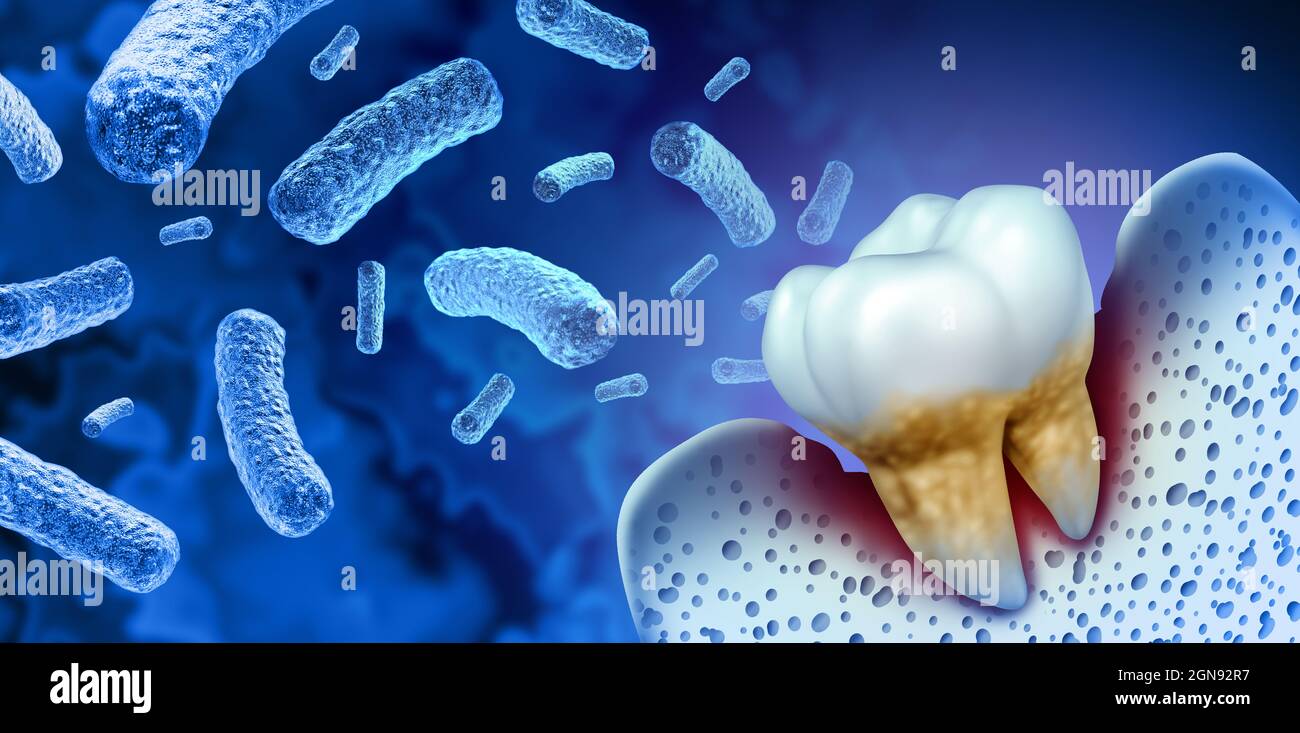 Tooth bacterial infection and teeth decay disease as an unhealthy molar with periodontitis due to poor oral hygiene health problem as an infectious. Stock Photo