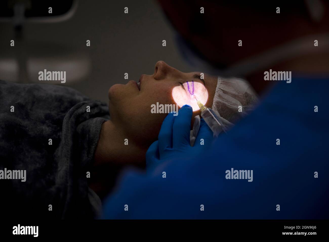 Surgeon process of blepharoplasty surgery.Apply anesthesia in eyelid