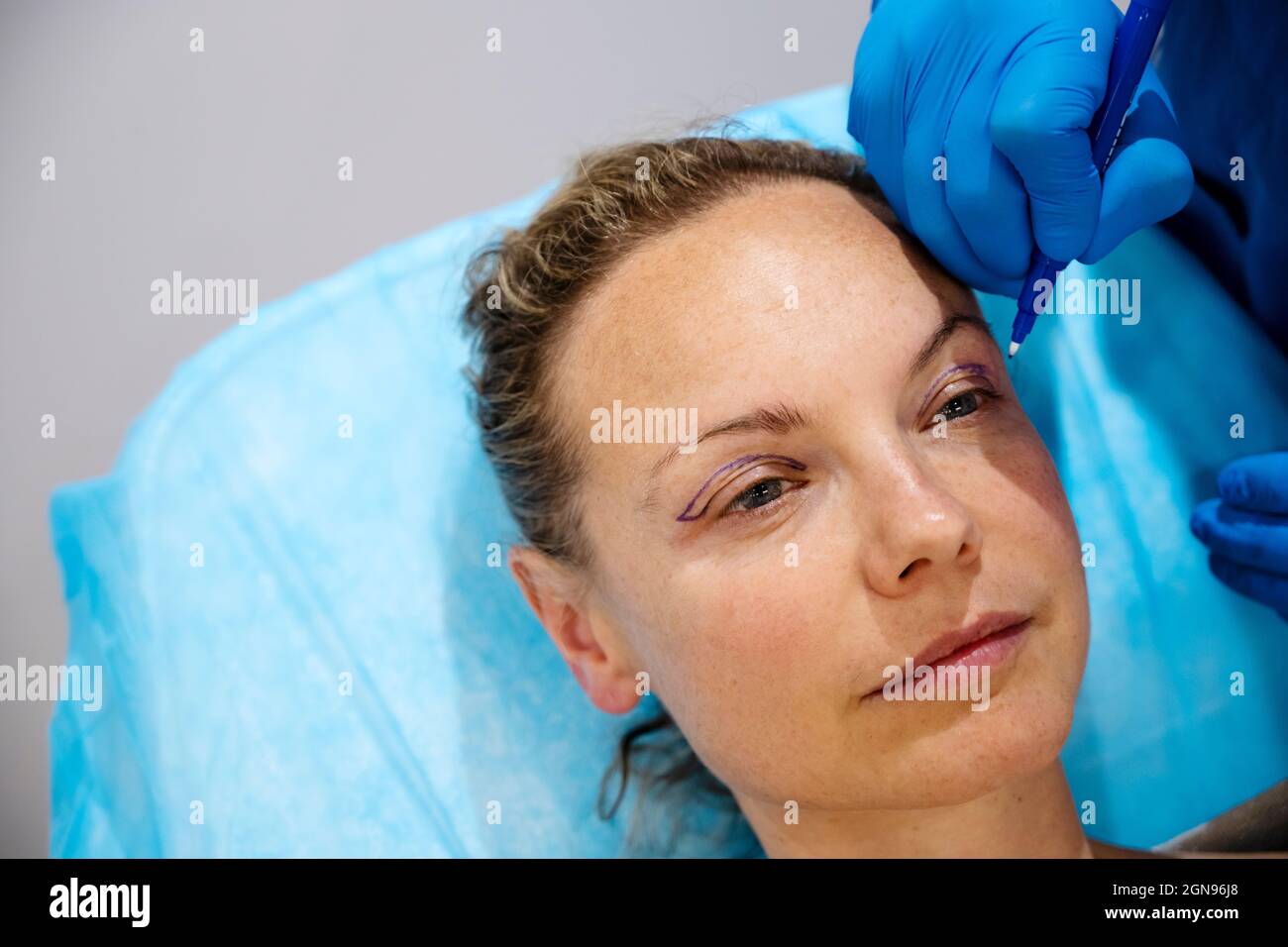 Surgeon drawing line on girl eye with marker preparing for procedure. Stock Photo