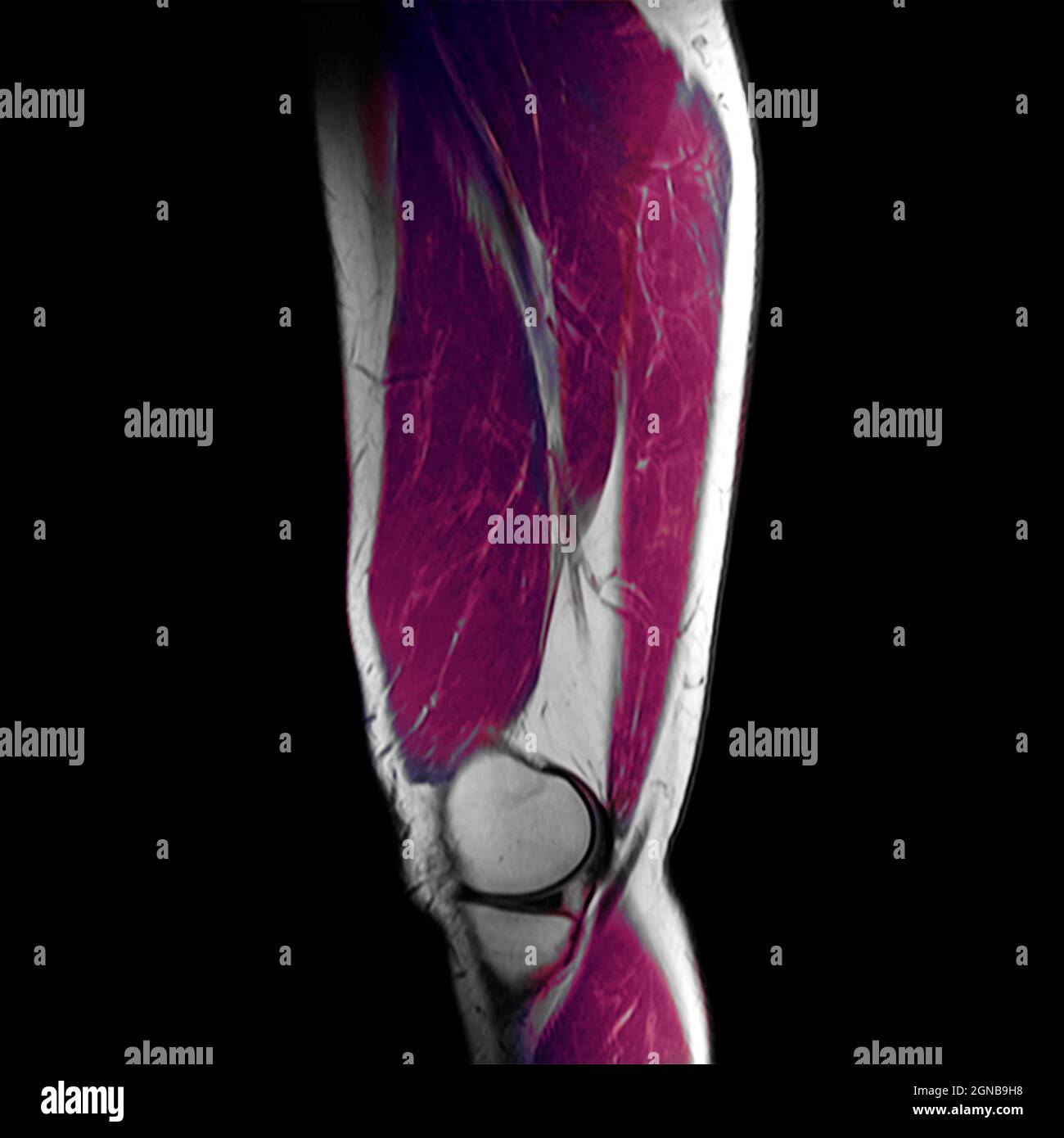 MRI of an adult's male thigh Stock Photo