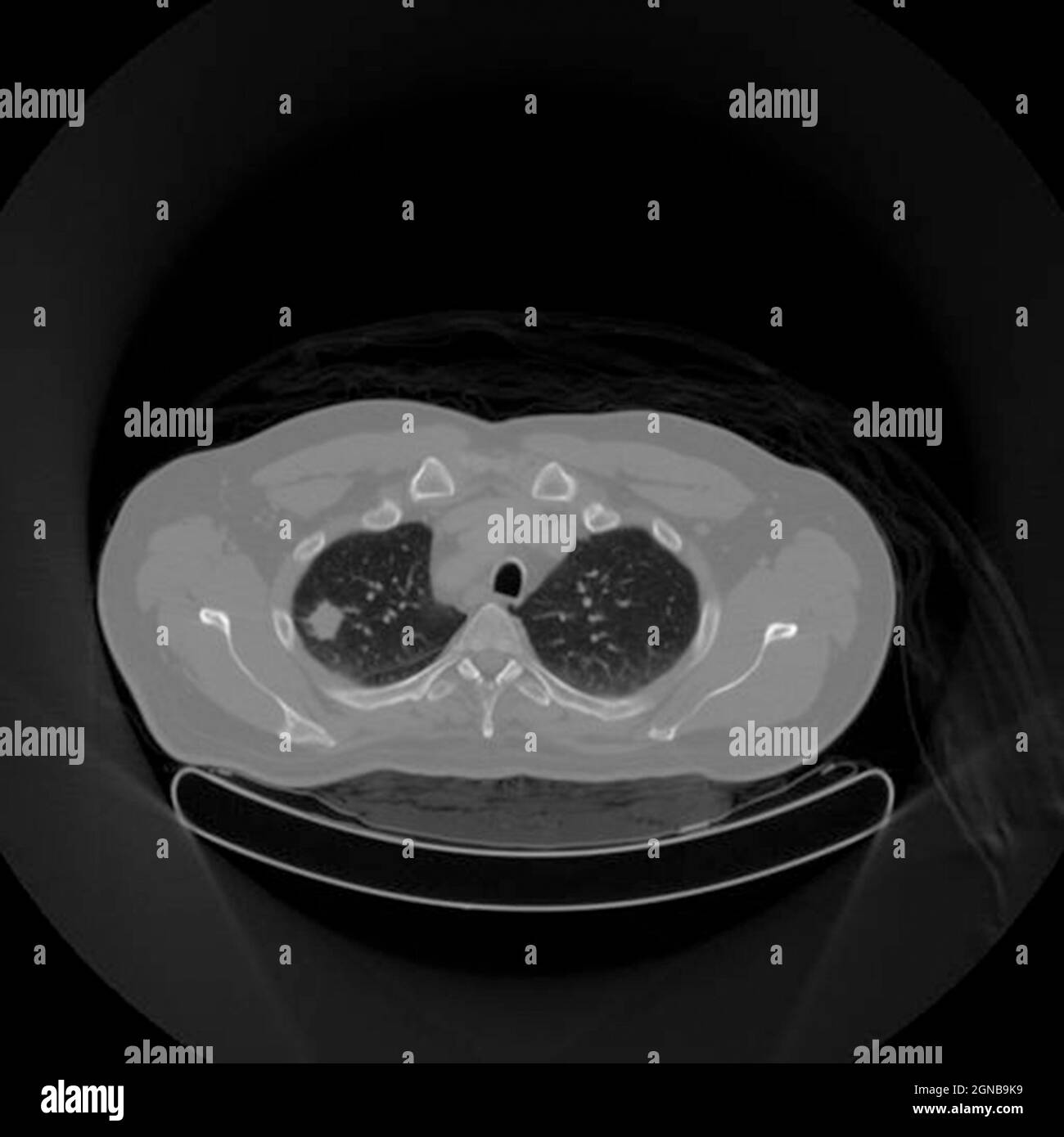 Positron emission tomography (PET) scan of a male, 54 year old patient. A tumour can be seen in the  left upper lobe of his lungs Stock Photo
